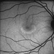Plaquenil Toxicity